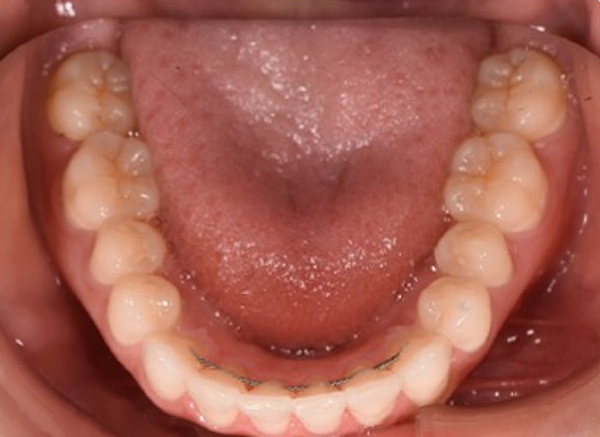 KF after lower Image