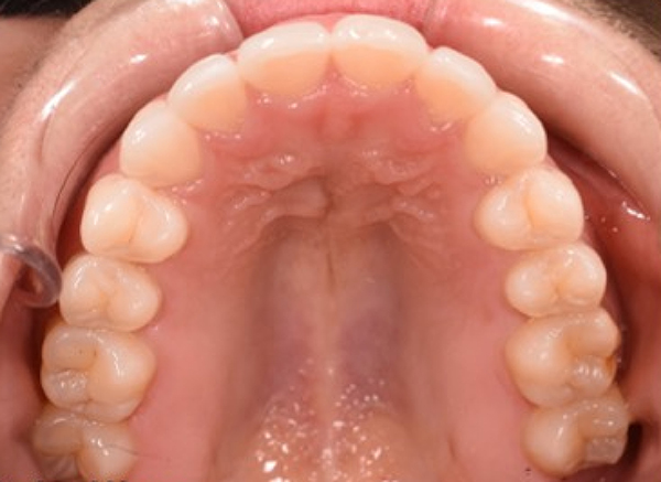 KF after upper Image