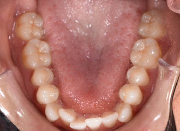 KF before lower Image