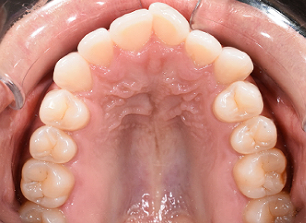 KF before upper Image